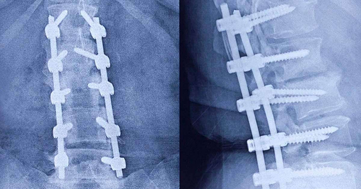Spinal Fusion Surgery
