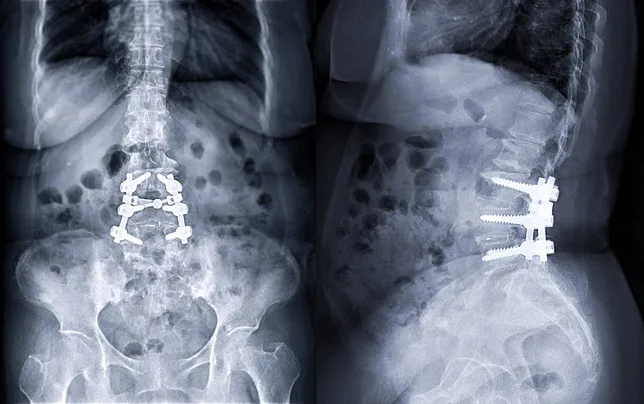 Disc Replacement Surgery