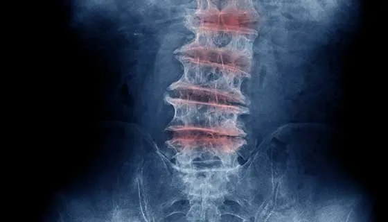 Degenerative Disc Disease Treatment
