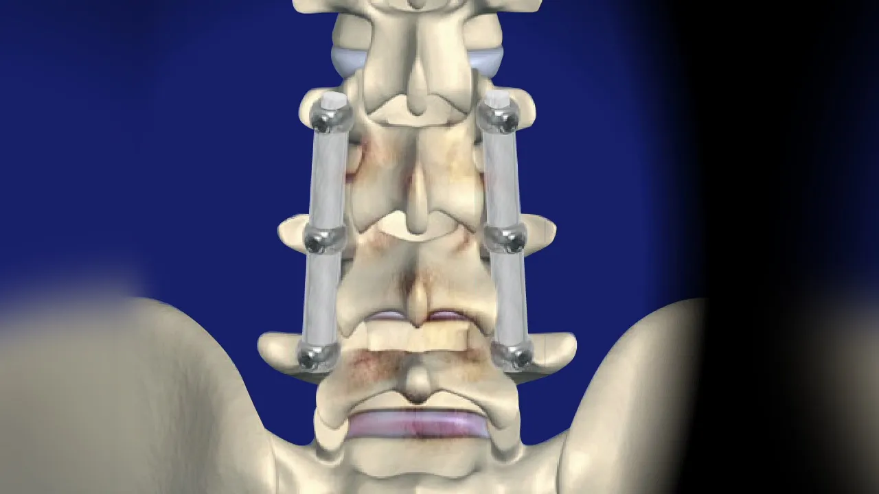 Spine Stabilization Procedures