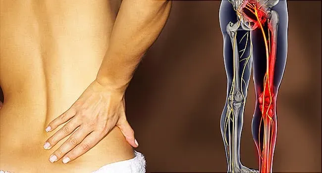 Sciatica Treatment