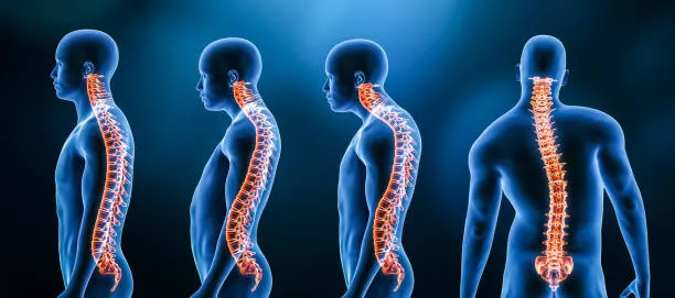 Kyphosis &amp; Lordosis Correction