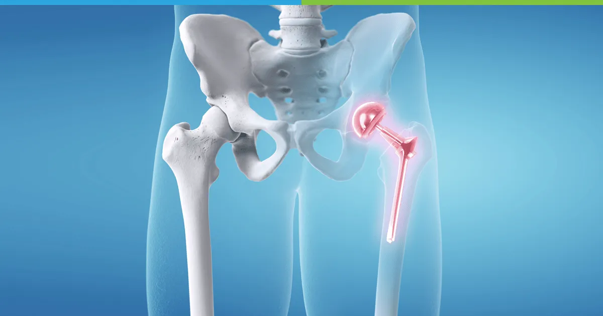 Hip Replacement Surgery