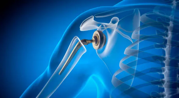 Shoulder Replacement Surgery