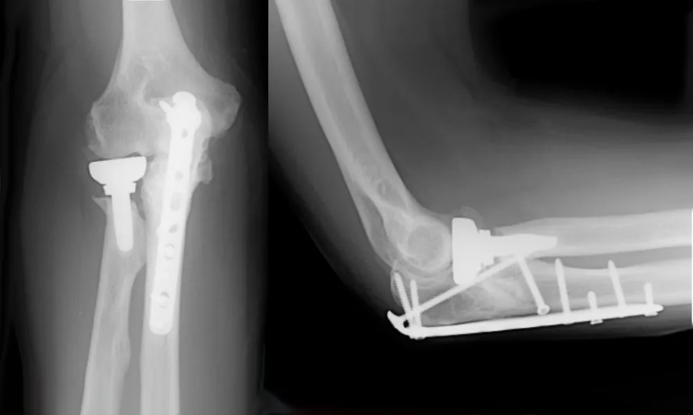 Elbow Replacement Surgery
