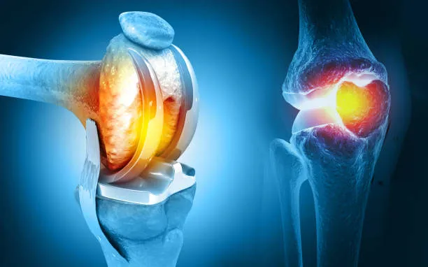Minimally Invasive Joint Replacement